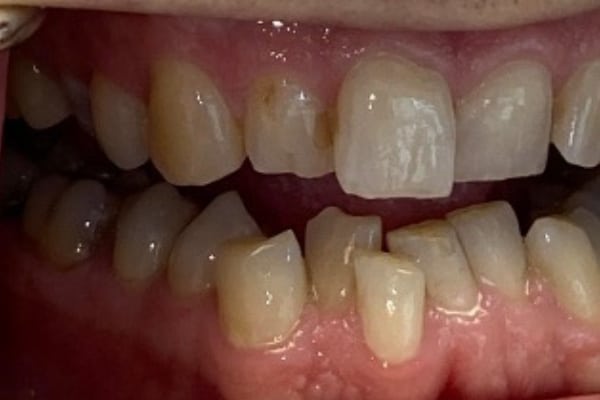 Cosmetic and Invisalign Cases - Before