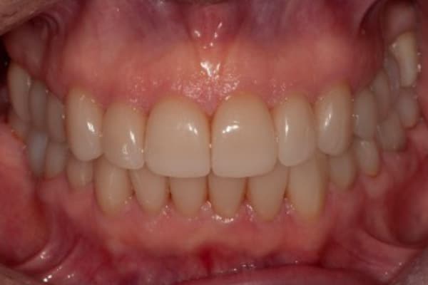 Full Mouth Rehabilitation After