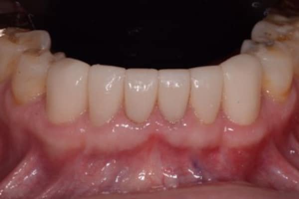 Lower Front Teeth After