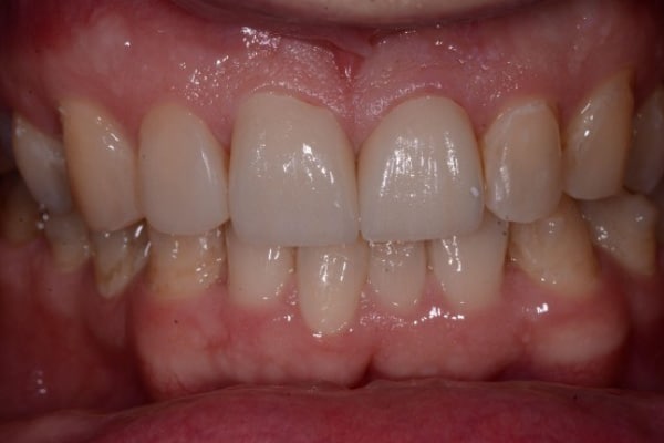 Cosmetic and Invisalign Cases - After One