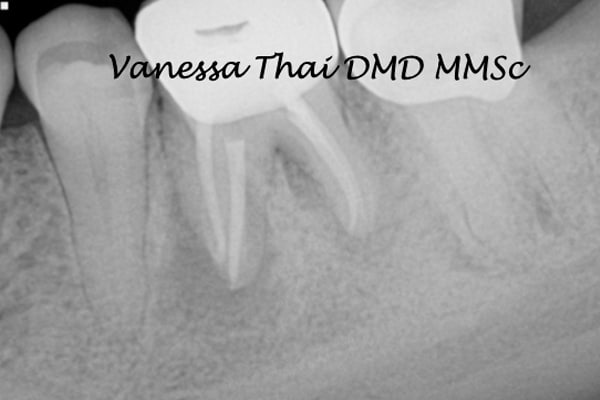 Non-Surgical Root Canal Therapy