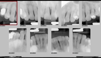 Full Mouth Implants Xrays
