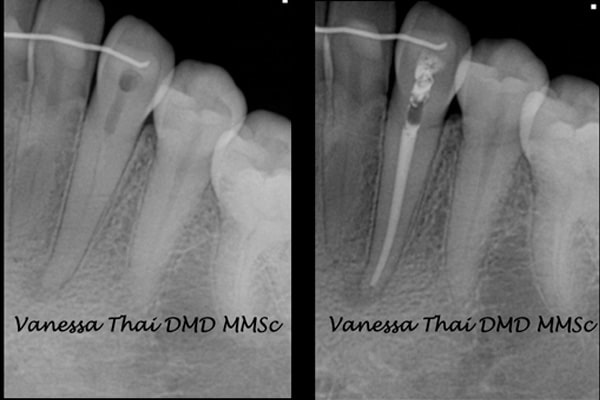 Non-Surgical Root Canal Therapy - Xrays