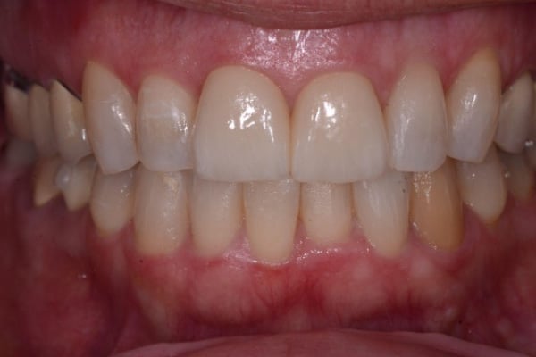 Cosmetic and Invisalign Cases - After One