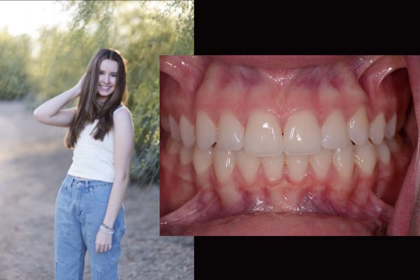 Teenager After Invisalign