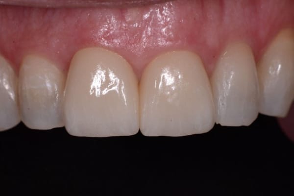 Cosmetic and Invisalign Cases - After Two