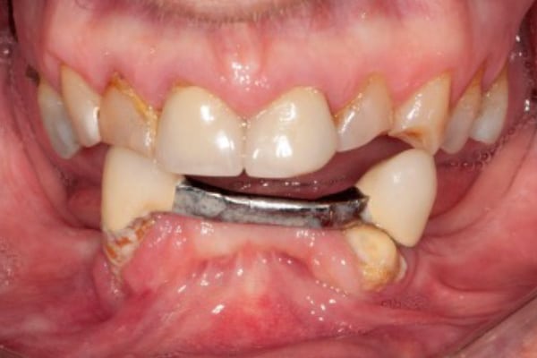 Denture Case Before