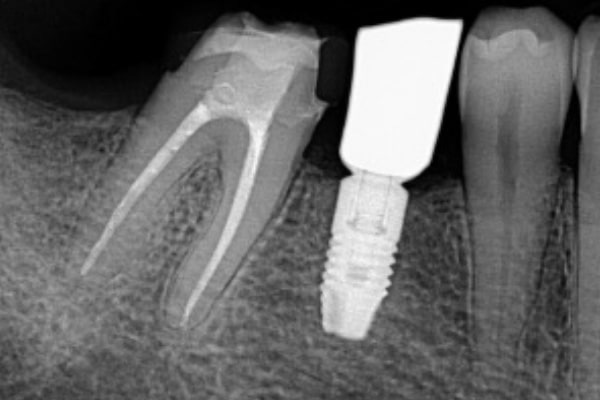 Endodontic Procedure After