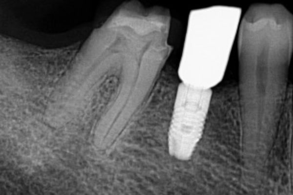 Endodontic Procedure Before