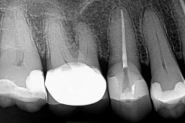 Endodontic Procedure After