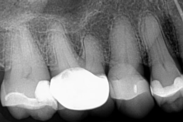 Endodontic Procedure Before