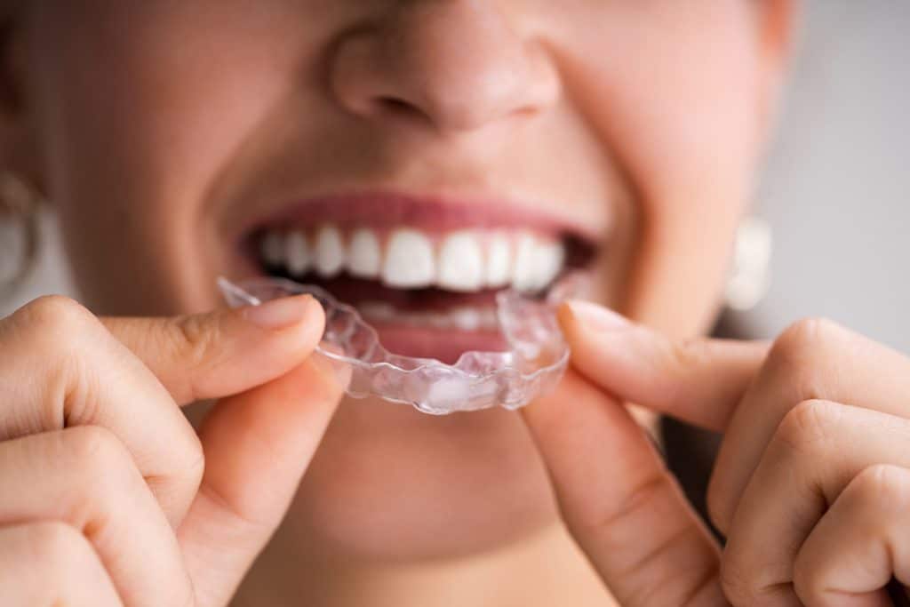 Can Invisalign Fix an