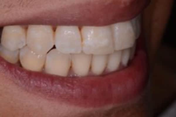 Full Invisalign Case - After - 1st Image