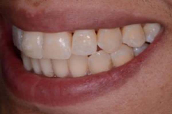 Full Invisalign Case - After - 2nd Image