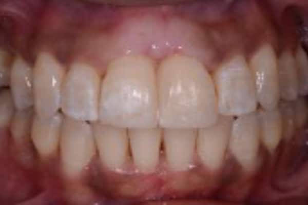 Full Invisalign Case - After - 3rd Image