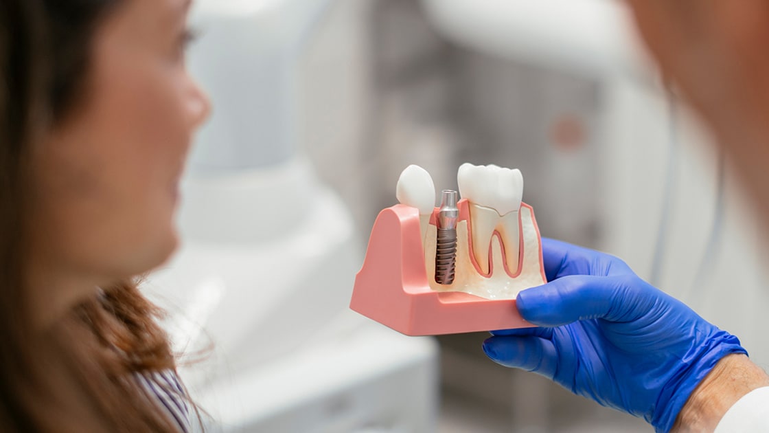 Dentist showing a Dental Implant Model to a patient