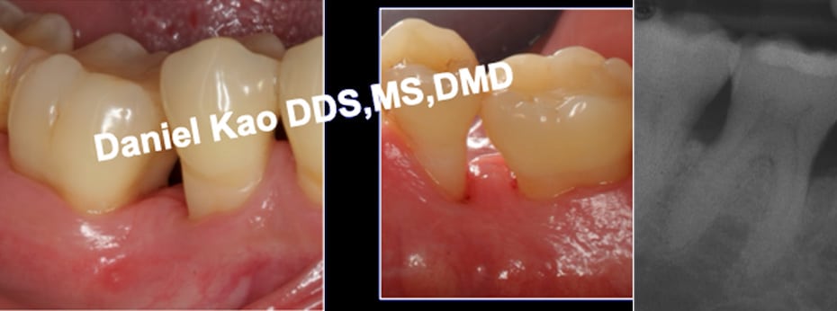 Periodontal Picture After Treatment