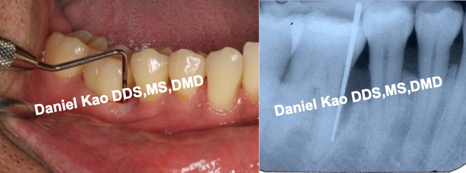 Periodontal Treatment Before Picture